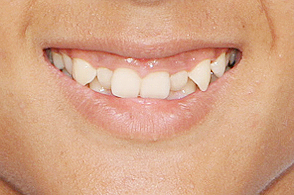 교정 전 미소