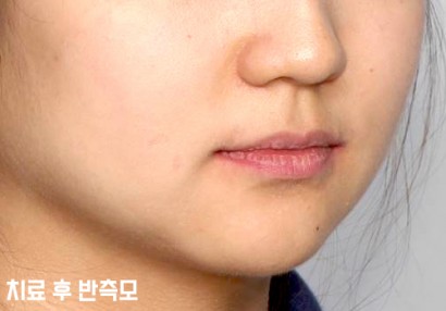 확장구외후