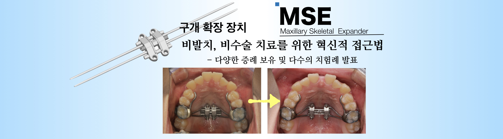 mse